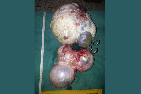 Uterine Fibroids removal in Kolkata